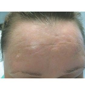 Patient after Scarlet-S RF treatment for burns - Ideal Body Clinic Montreal
