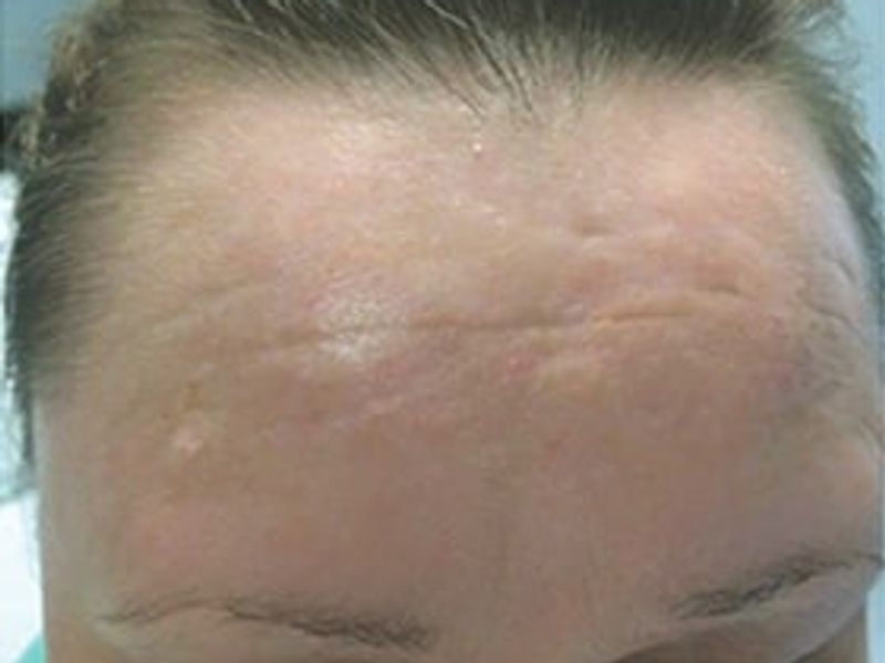 Patient after Scarlet-S RF treatment for burns - Ideal Body Clinic Montreal