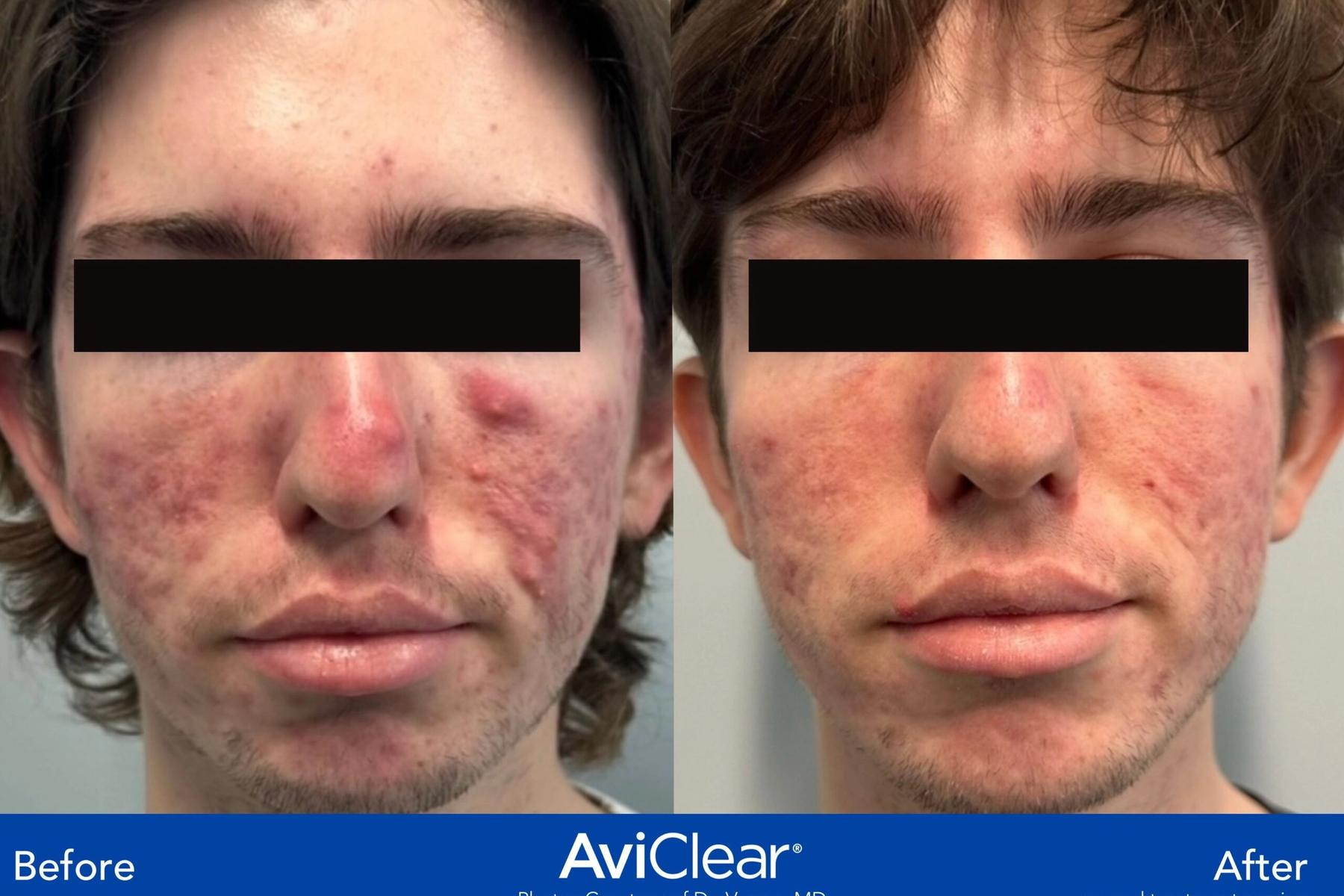 Acne and Acne Scar Treatments Offered at Ideal Body Clinic Montreal