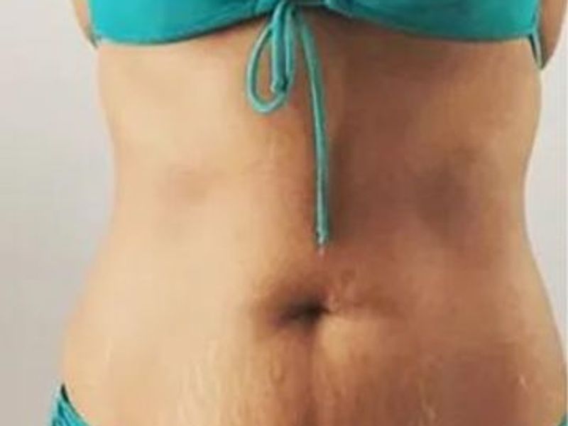 Love handles After Slimwave Montreal treatment at Ideal Body Clinic