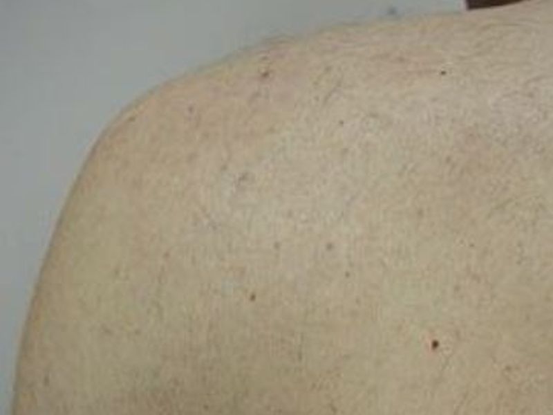 After Fotona Laser Skin Treatment for body hair removal - Montreal