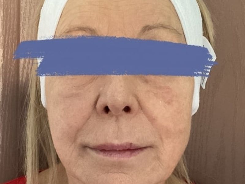 After Female Dermal Fillers procedure at our Montreal aesthetic clinic