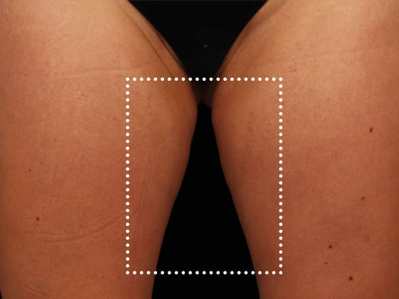 Thigh gap Before Emsculpt NEO Body Contouring fat removal therapy in Montreal