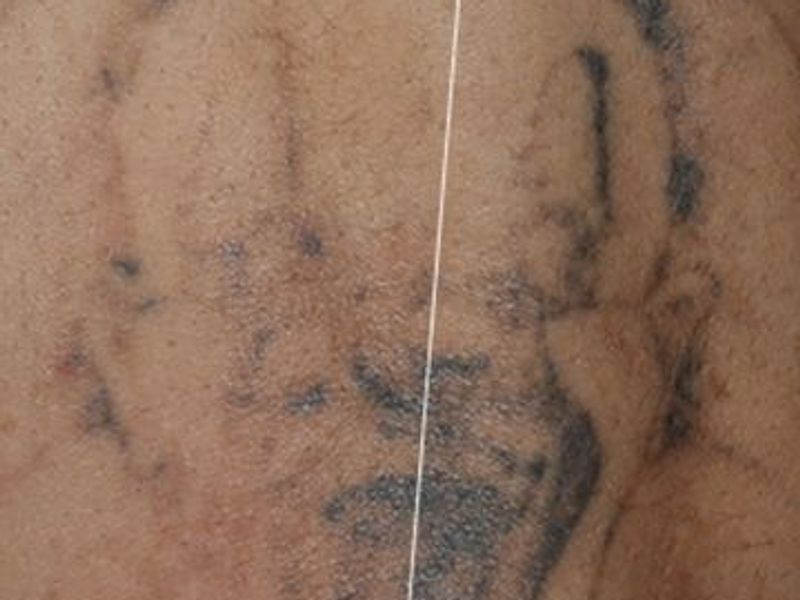 After CUTERA Enlighten Tatto Removal Montreal