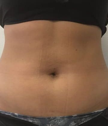 Before picture of fat reduction treatment in abdomen area with Venus Bliss Max treatment in Montreal