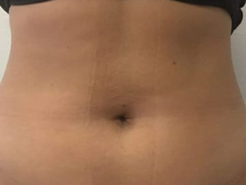 Before picture of fat reduction treatment in abdomen area with Venus Bliss Max treatment in Montreal