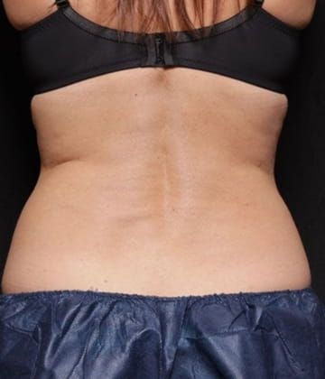 Love handles and back reduction before venus bliss max treatment in Montreal
