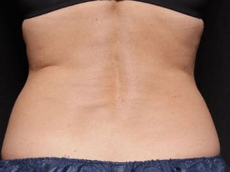 Love handles and back reduction before venus bliss max treatment in Montreal