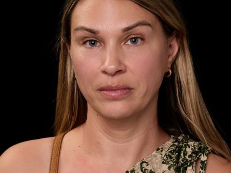 After picture: triLift non surgical face lift treatment for middle age woman in Montreal at Ideal Body Clinic