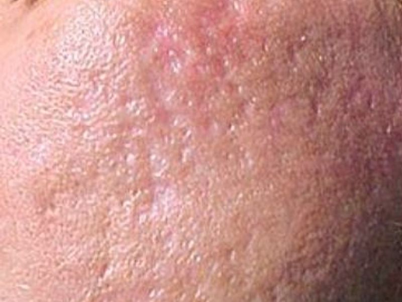 Before Fotona Laser Skin Treatment for acne and acne scars - Montreal