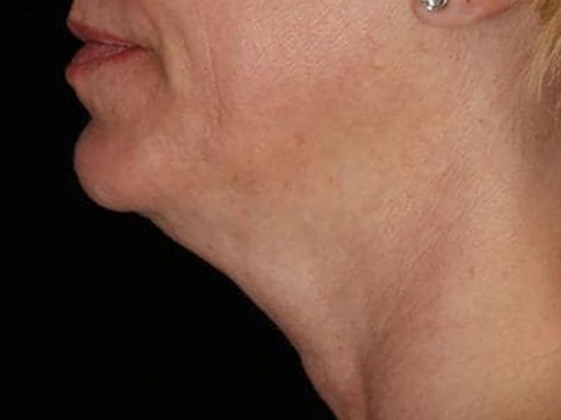 Before double chin Profound Radiofrequency Microneedling Skin treatment - Montreal