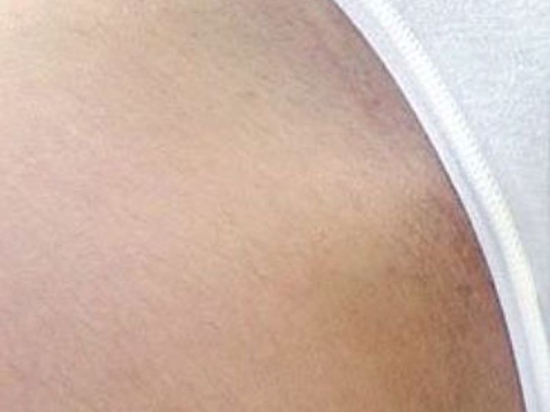 After Fotona Laser Skin Treatment for bikini hair removal - Montreal