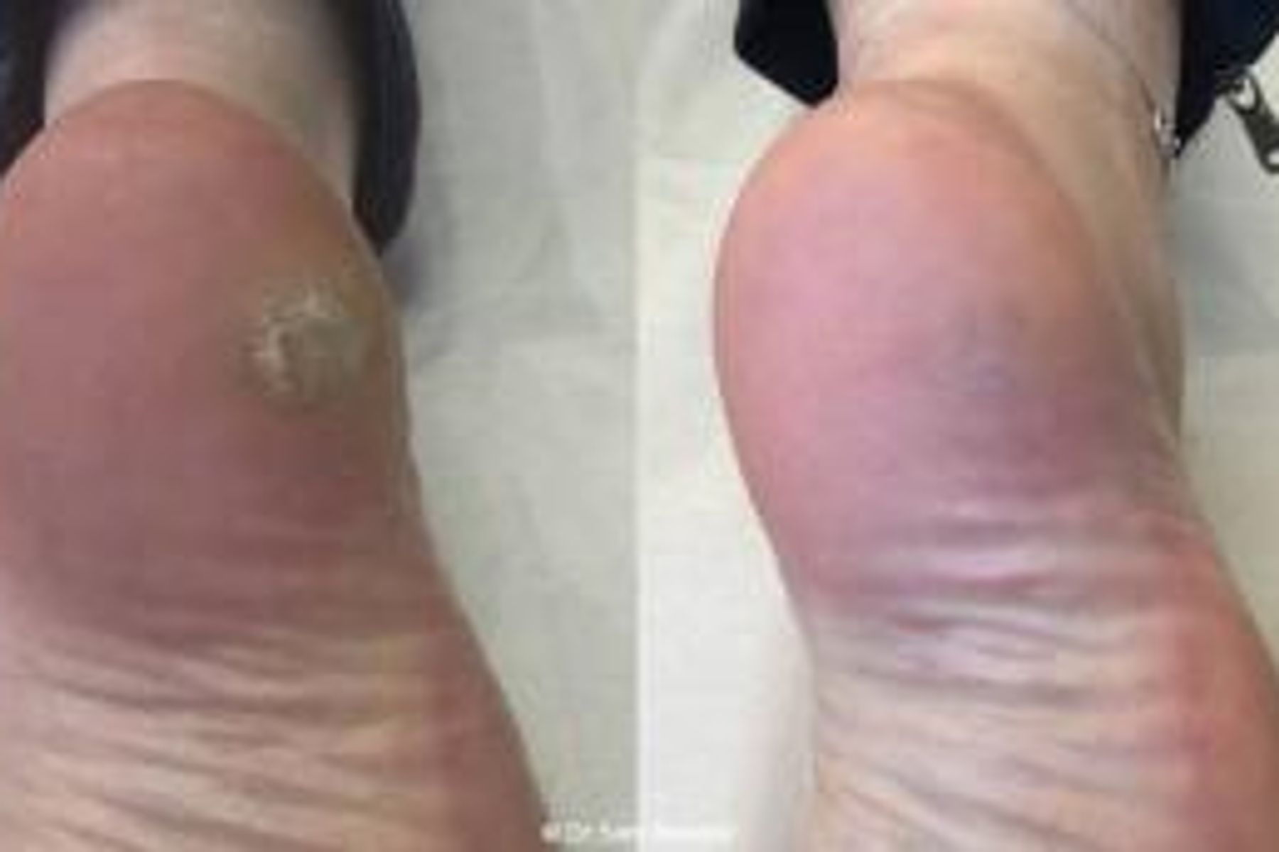Understanding Warts: Causes, Types, and Effective Treatments