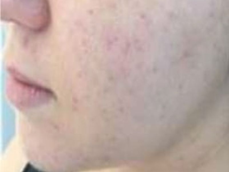 Patient after Scarlet-S RF treatment for acne and acne scars - Ideal Body Clinic Montreal