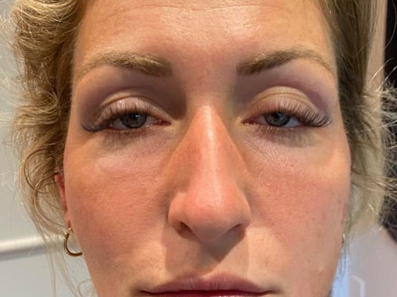 Droopy eyes and jaw before PDO thread lift procedure at our Montreal, Quebec aesthetic clinic