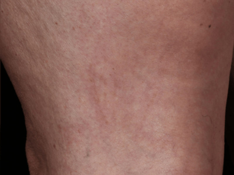 Spider vains removal after Excel HR treatment in Montreal