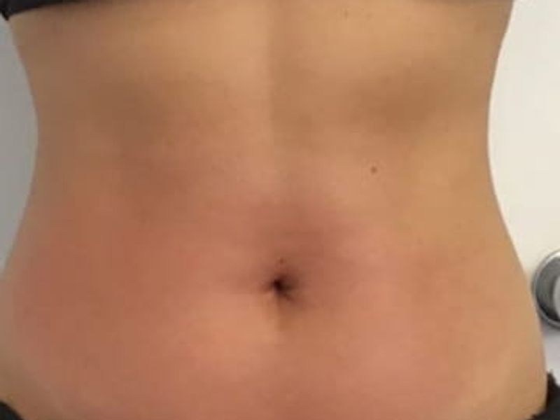 After picture of fat reduction treatment in abdomen area with Venus Bliss Max treatment in Montreal
