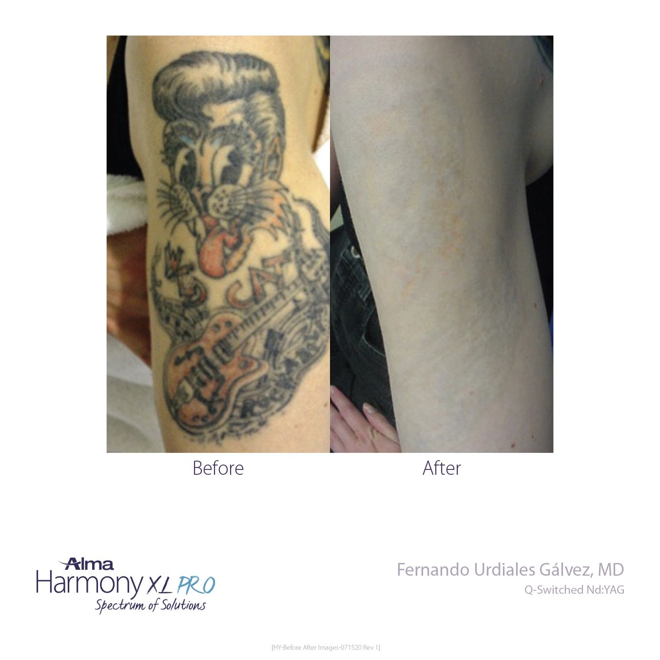 Laser Tattoo Removal | Underground Tattoos Watford, WD18