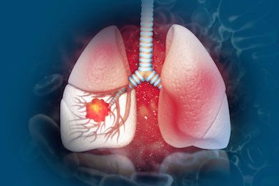 Small Cell SMASHERS: How Community, Advocacy, and Emerging Science Are Changing the Narrative in Small Cell Lung Cancer