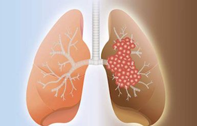 Taking Lung Cancer Screening on the Road