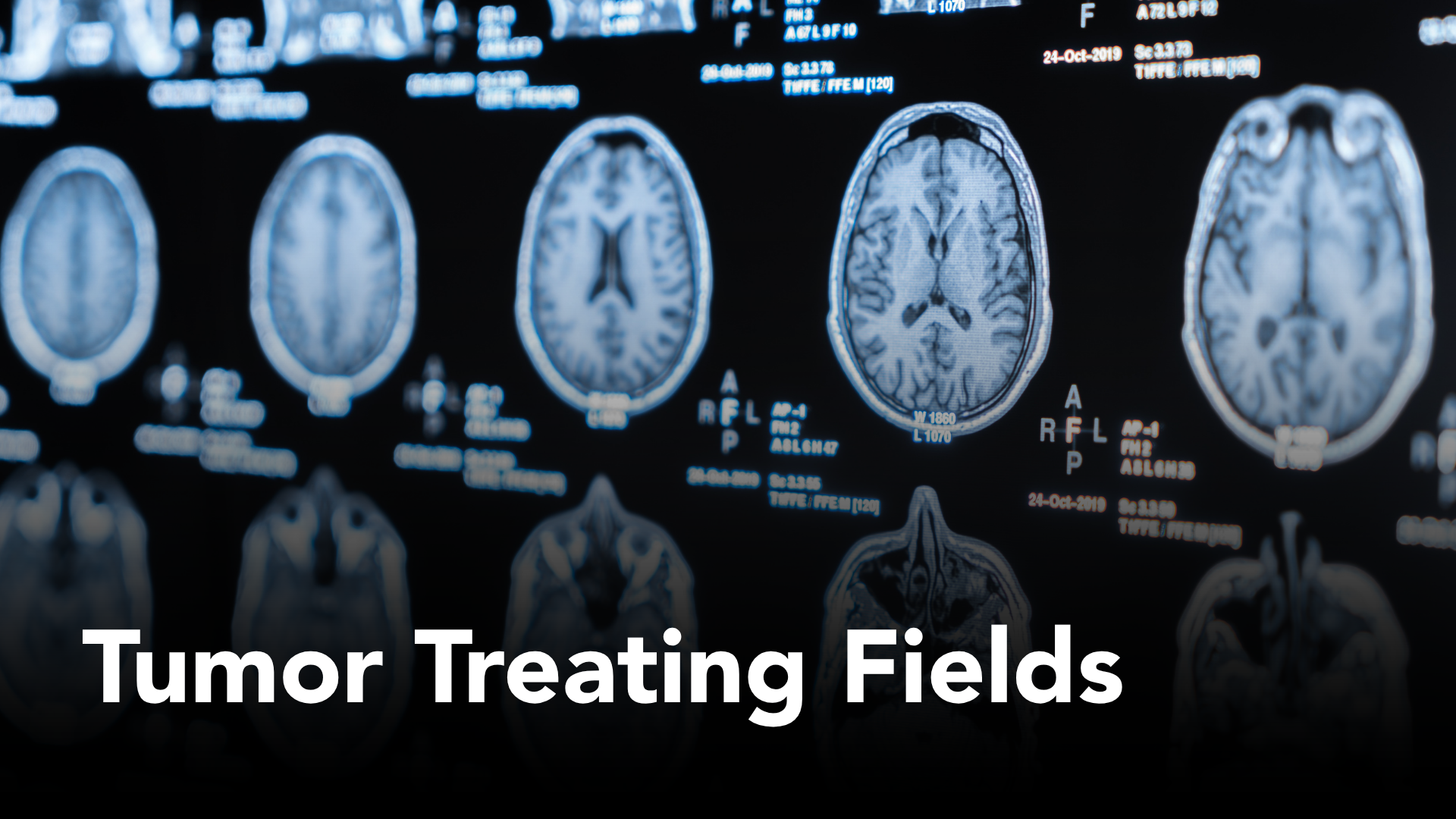 Bringing Tumor Treating Fields to Practice: Lessons From Three Cancer Programs