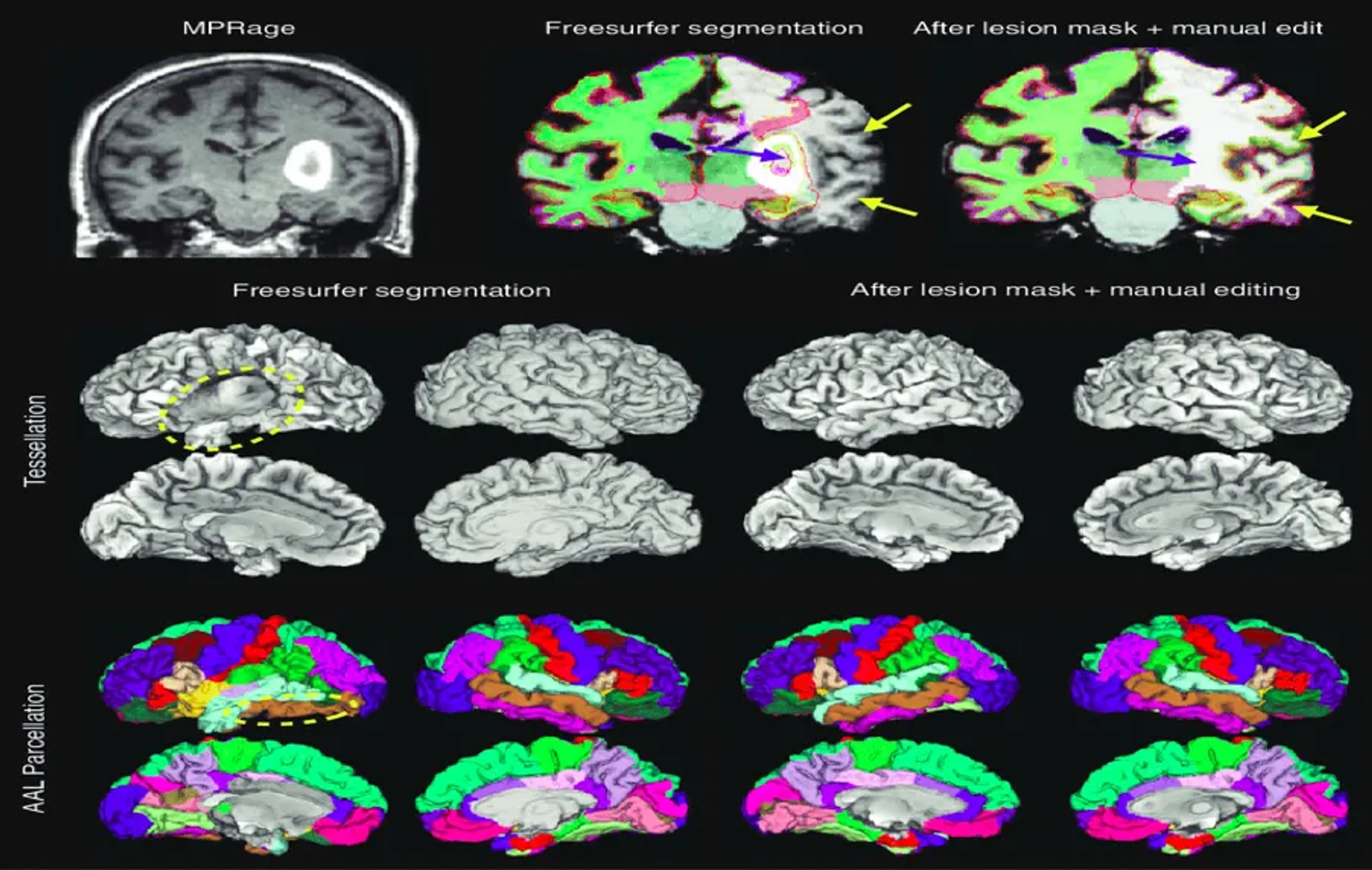 MRI