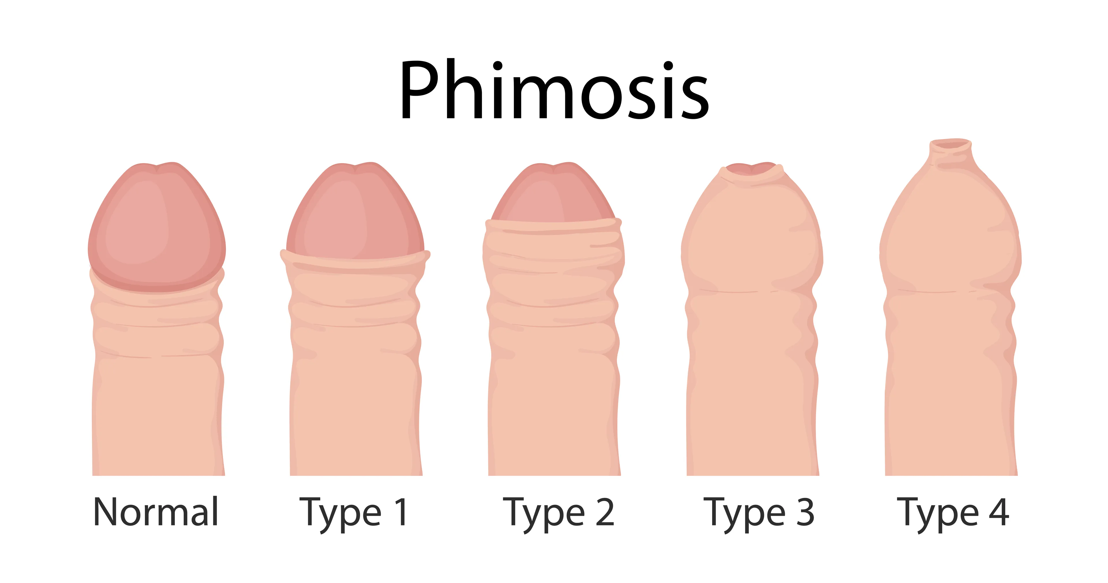 Medical illustration showing foreskin retractability in phimosis: a normal penis with fully retractable foreskin, followed by four types of phimosis (Types 1–4) with progressively reduced foreskin retraction, from partial exposure of the glans to no exposure at all.