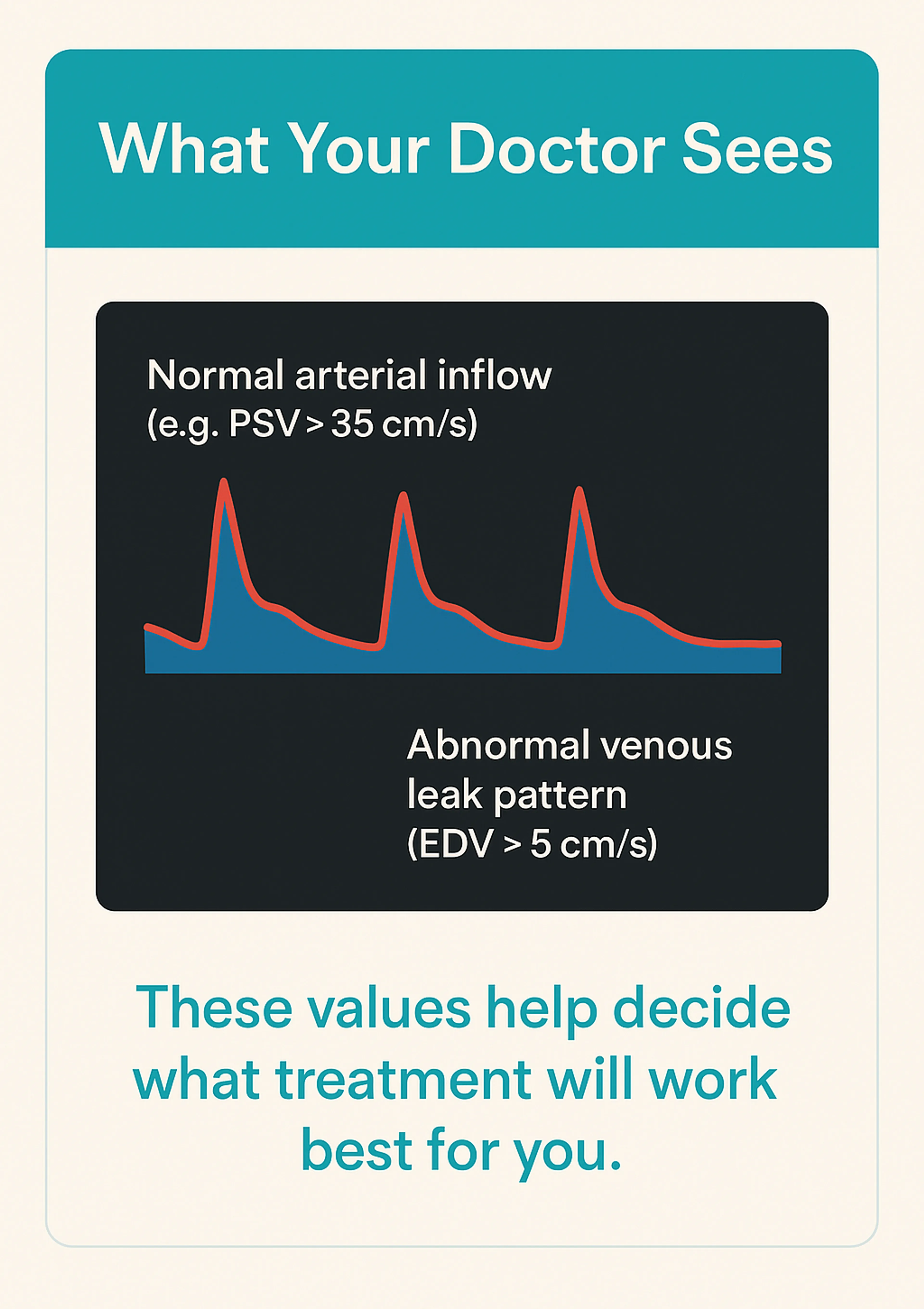 alt="Stylised Doppler waveform showing normal arterial inflow and abnormal venous leak pattern."