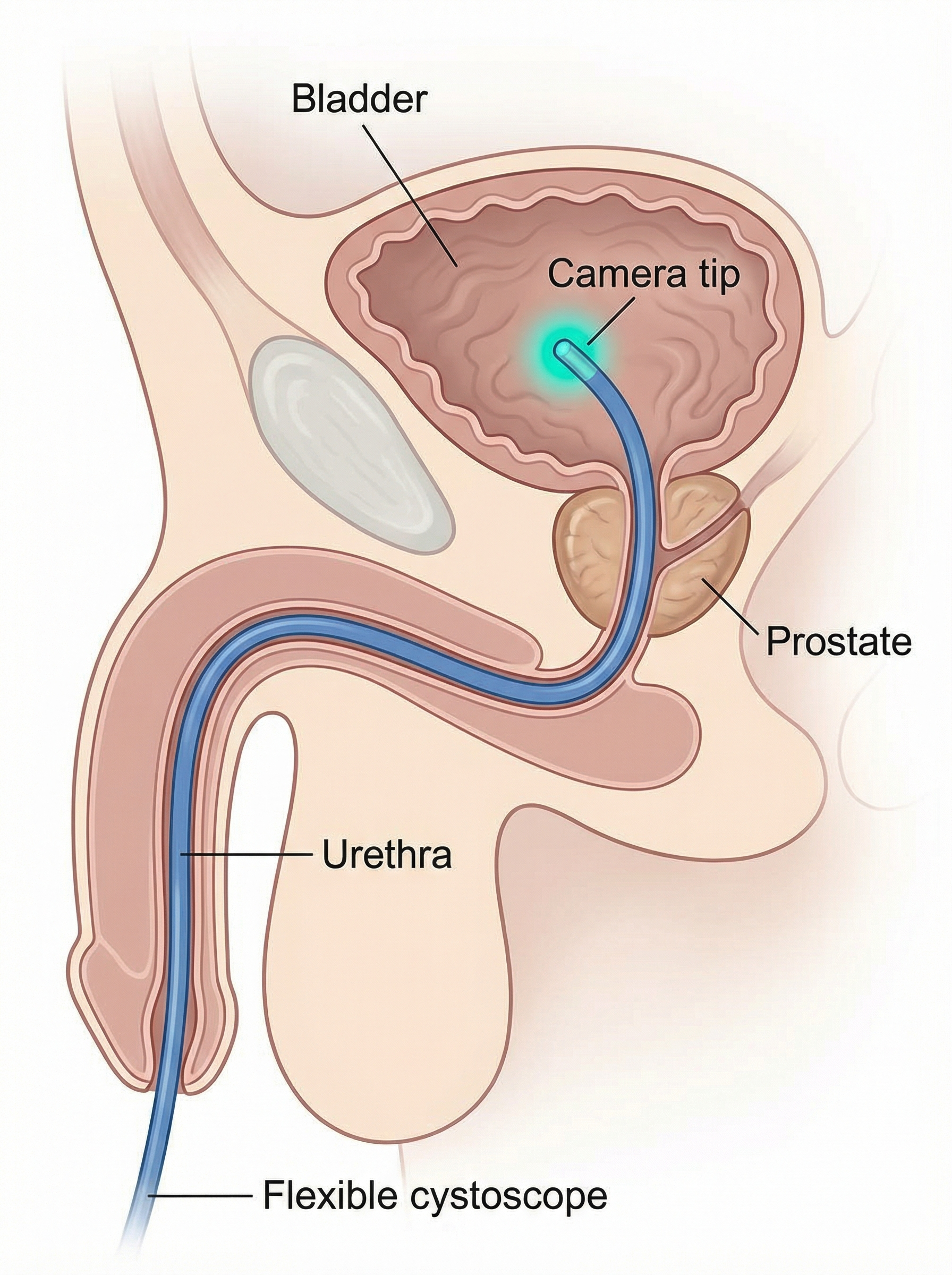 simplified anatomical section of a flexible cystoscopy passing through male genitalia