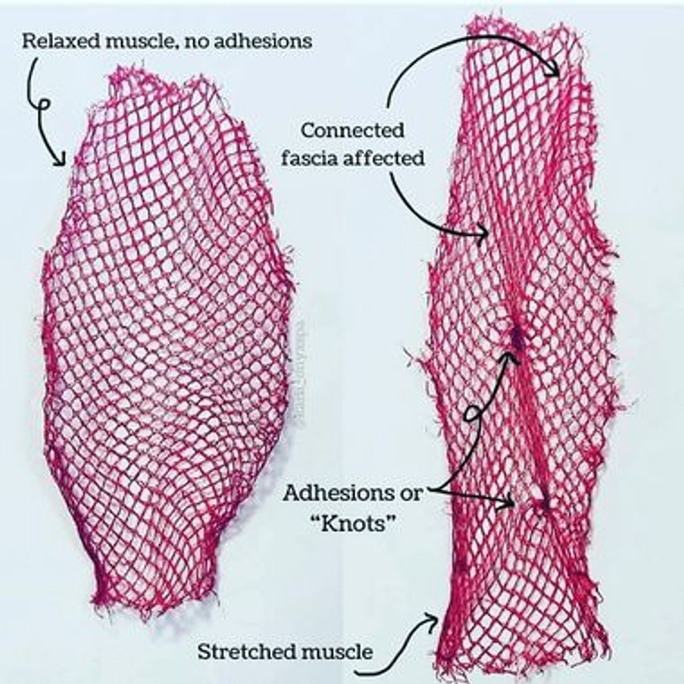 Diagram comparing healthy fascia with fascia containing adhesions and restrictions.
