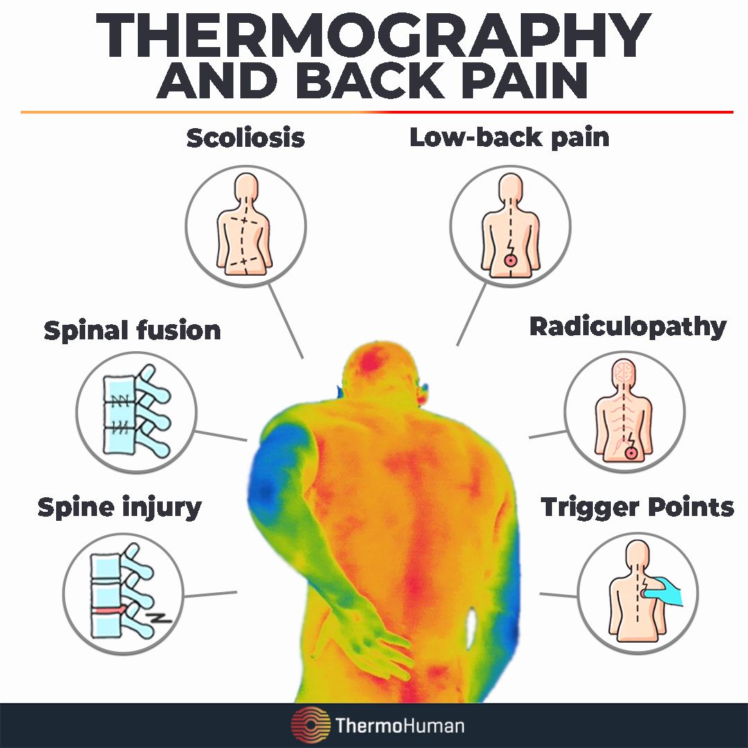Thermography and back pathology | ThermoHuman