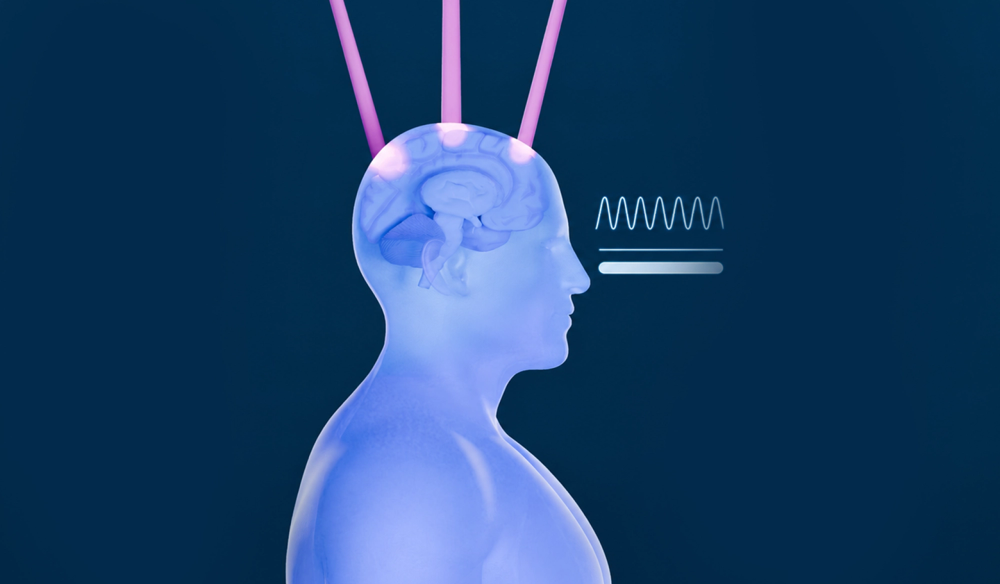 Schematic side view of a head: four separate light modules on the skull and one applicator in the nostril, each casting a narrow beam inward, beside a uniform waveform and a solid intensity bar