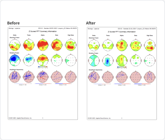 Before and after Z-scored FFT summary maps (Laplacian montage) from the mold illness case.