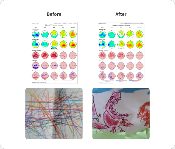 Before and after Z-scored FFT summary maps from the autism case, with the childโs drawings before and after.