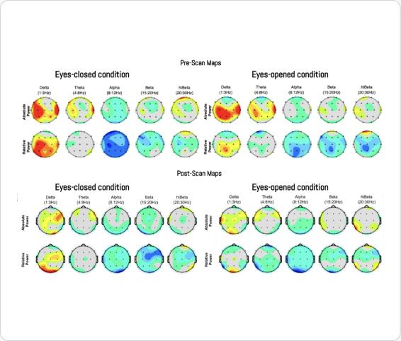 Pre-scan and post-scan absolute and relative power maps for eyes-closed and eyes-opened conditions from the TBI case.