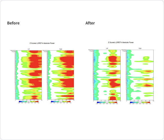 Before and after Z-scored LORETA absolute power maps from the Parkinson’s case.