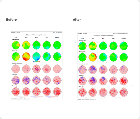 Before and after Z-scored FFT summary maps (LinkEars montage) from the Alzheimer’s case.