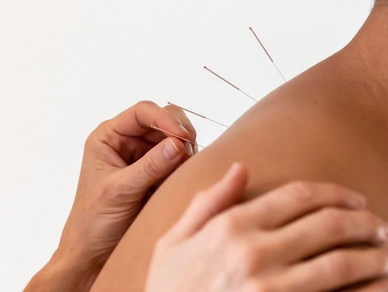 Acupunctuur