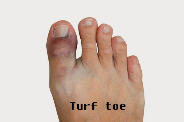 Turf Toe: symptoms and state-of-the-art treatment options