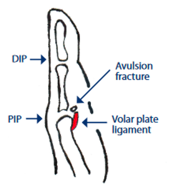 Volar plate ligament injury of the finger hand therapy