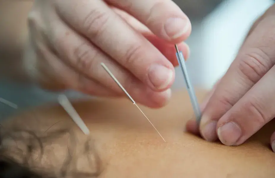Dry Needling Physiotherapy