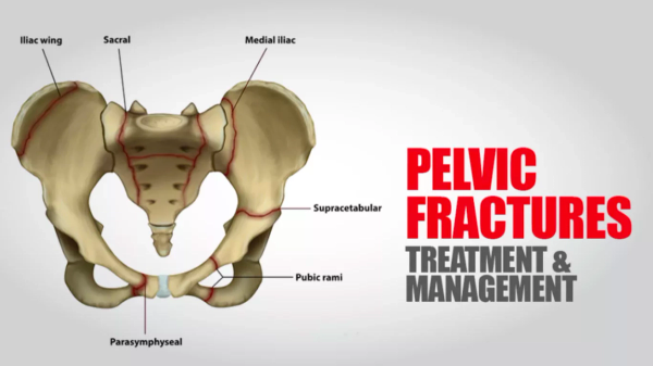 Pelvic Fracture Physiotherapy