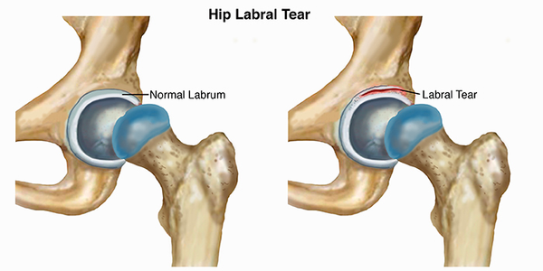 Hip labral tear physiotherapy | Phoenix Rehab Singapore