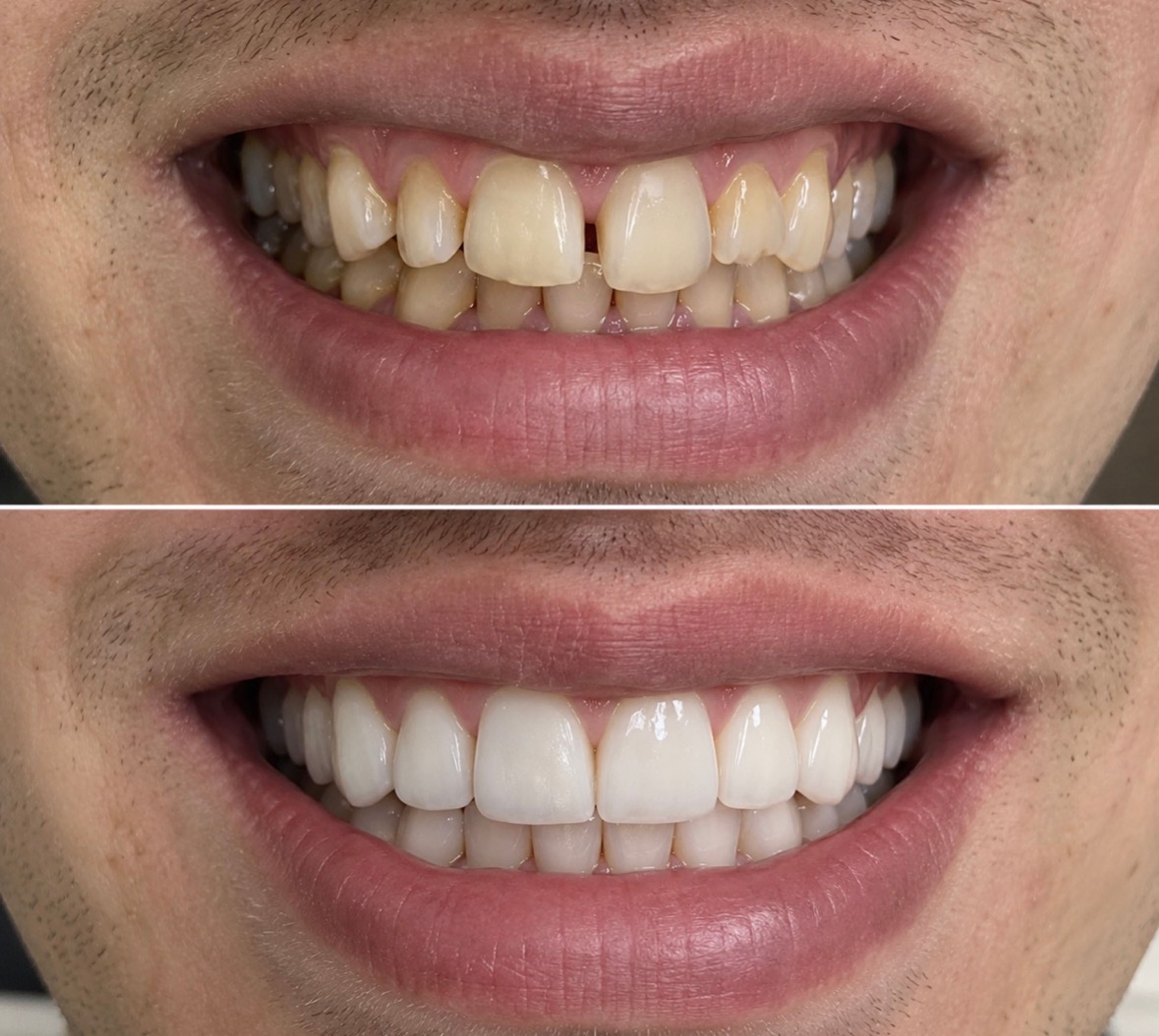 Mosoly a direkt héjkezelés előtt és után – Hollywood smile Esztergomban