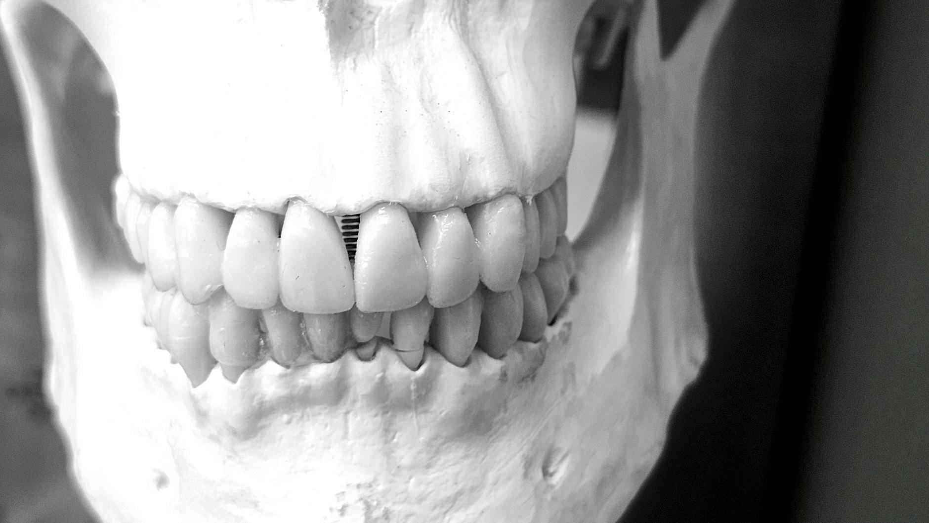 Zirkon, Vollkeramik oder Metallkeramik: Was passt wann?