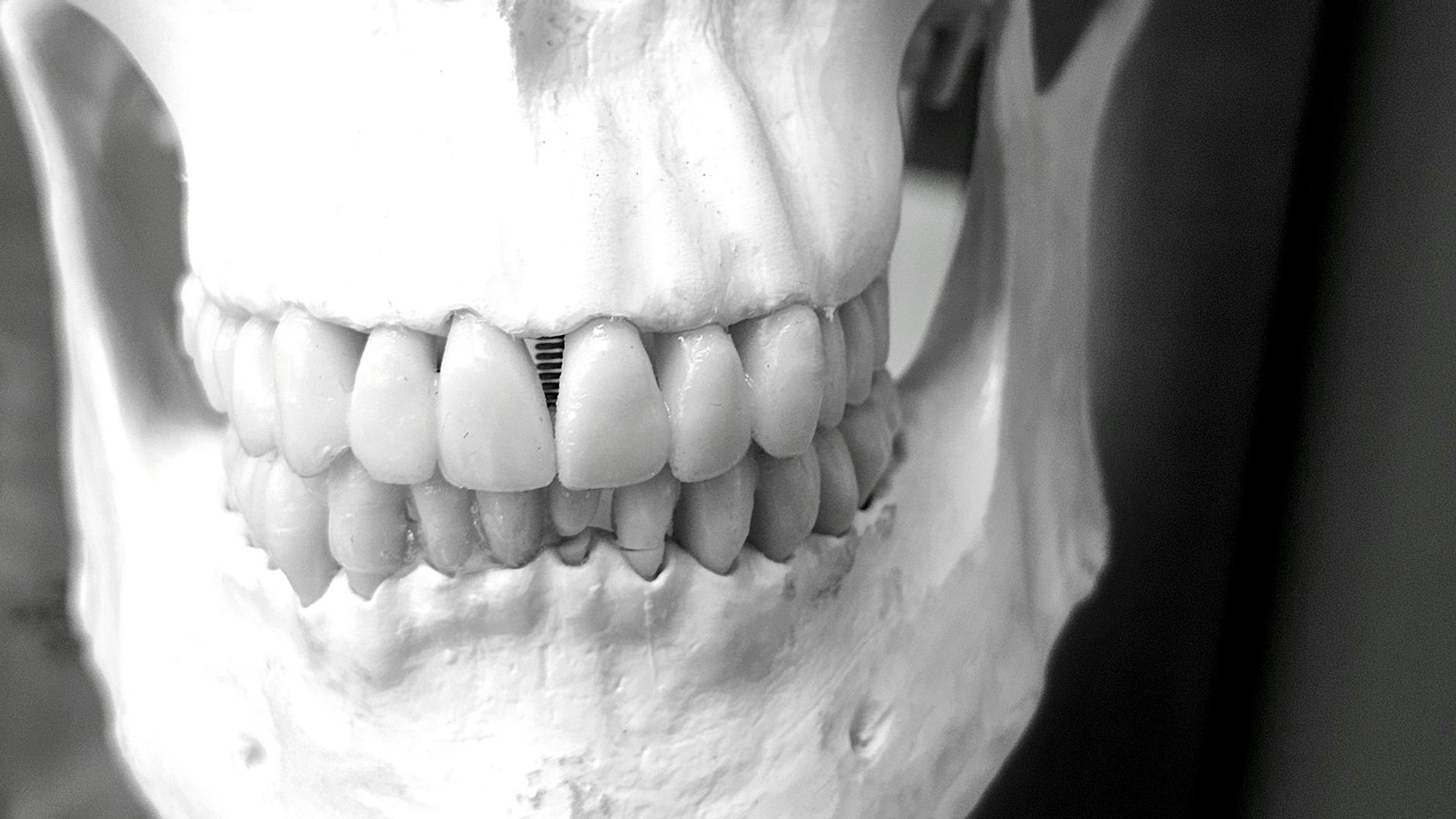 Zirkon, Vollkeramik oder Metallkeramik: Was passt wann?