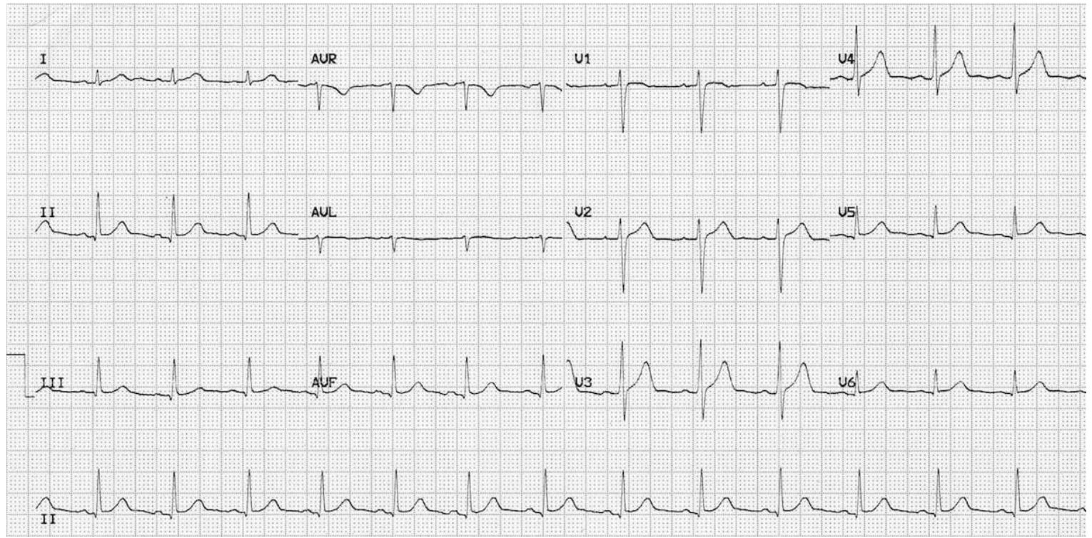 Patient ECG