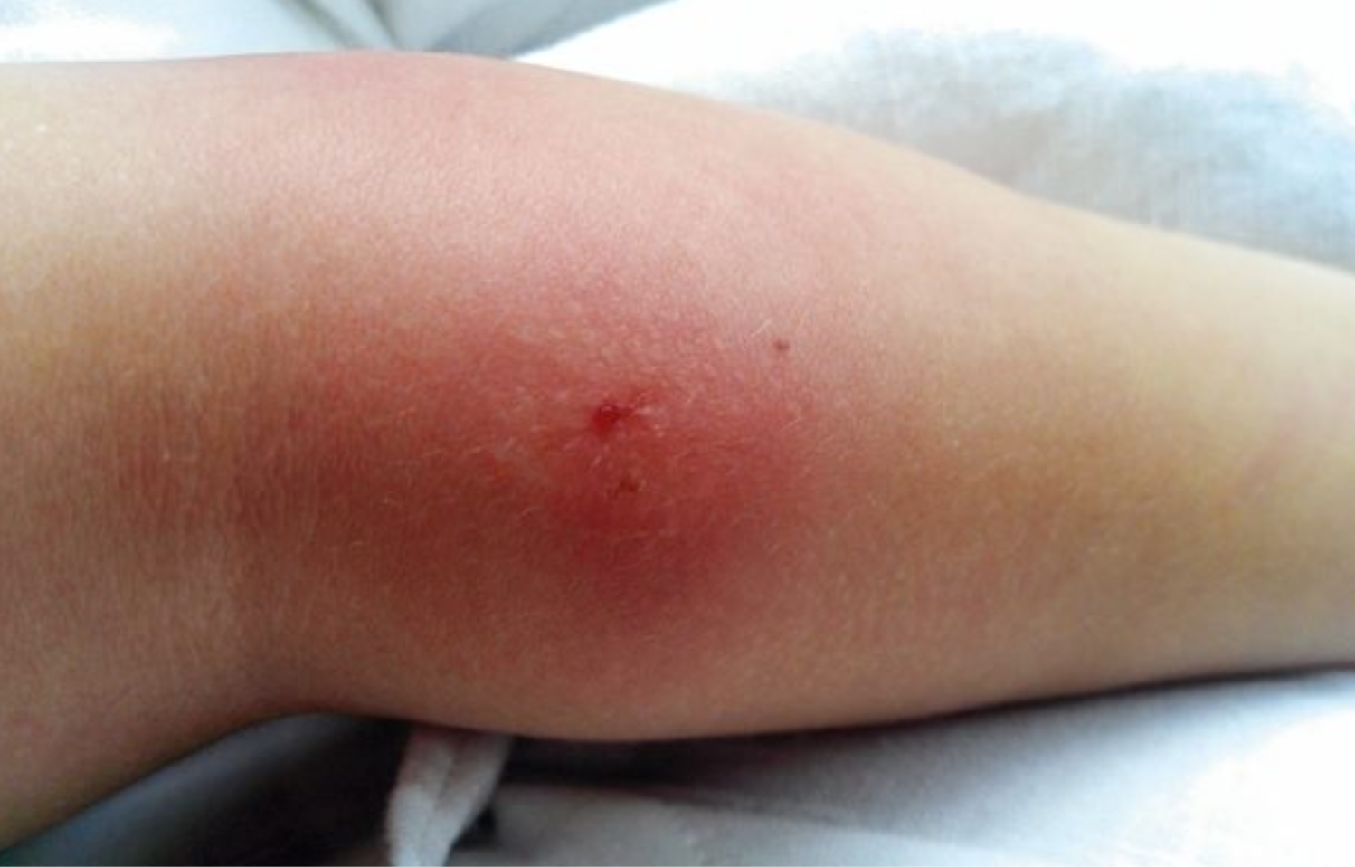 Patient rash