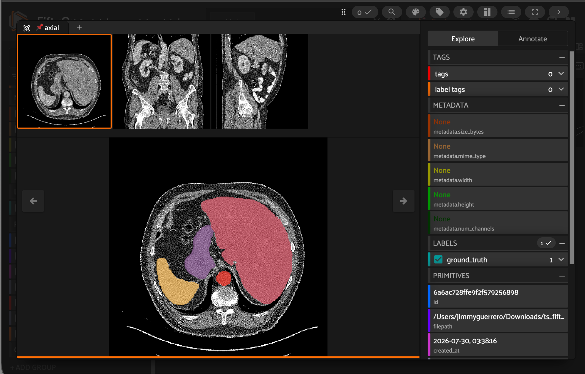 FiftyOne App showing a CT scan with TotalSegmentator organ masks overlaid in axial, coronal, and sagittal views.