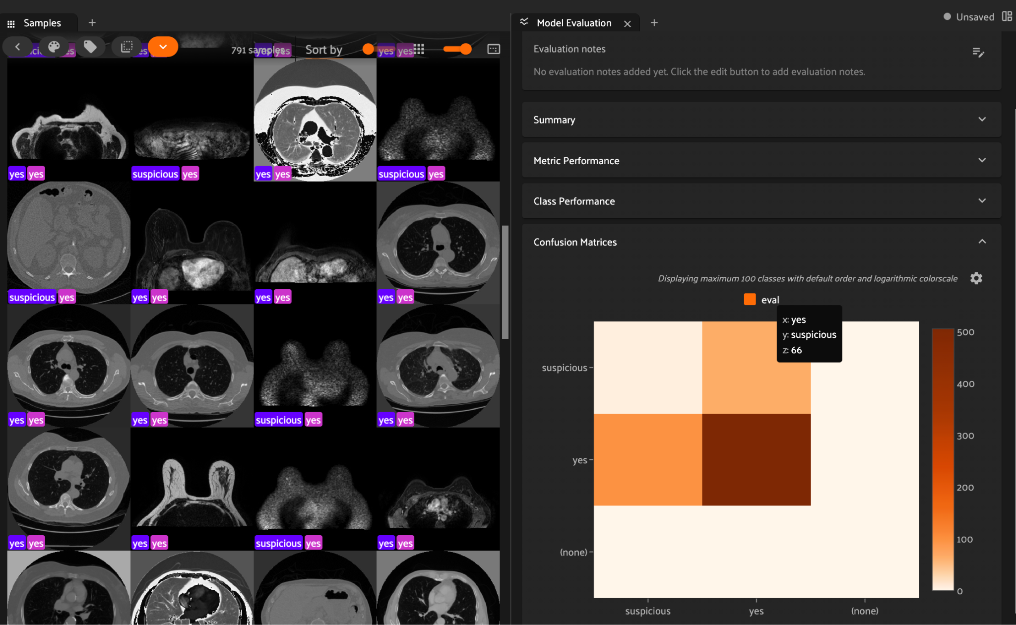 FiftyOne Model Evaluation panel showing a confusion matrix with a tooltip revealing 66 cases where the model predicted "yes" but the ground truth was "suspicious," alongside the corresponding CT scan samples.